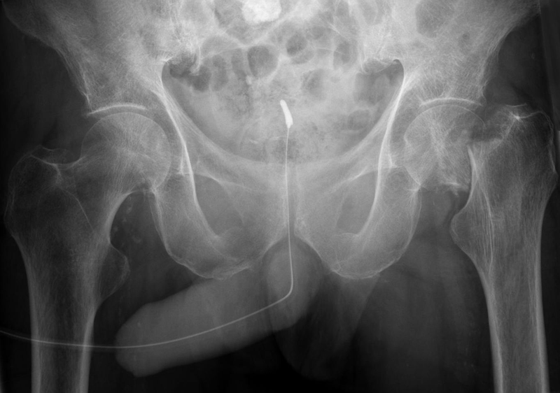 Radiografía duna e fractura de pene. Wikimedia Commons